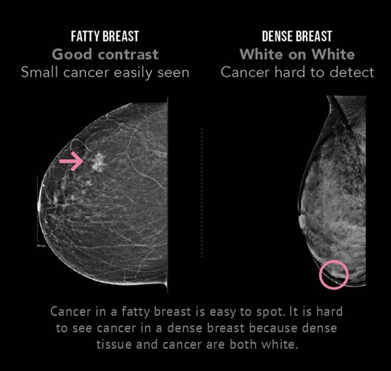 Why Do Young Females Get Breast Cancer 8 Risk Factors