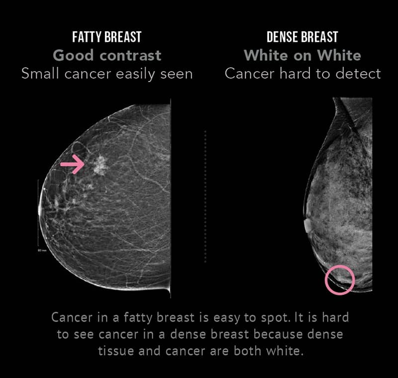 Breast Cancer and Breast Density