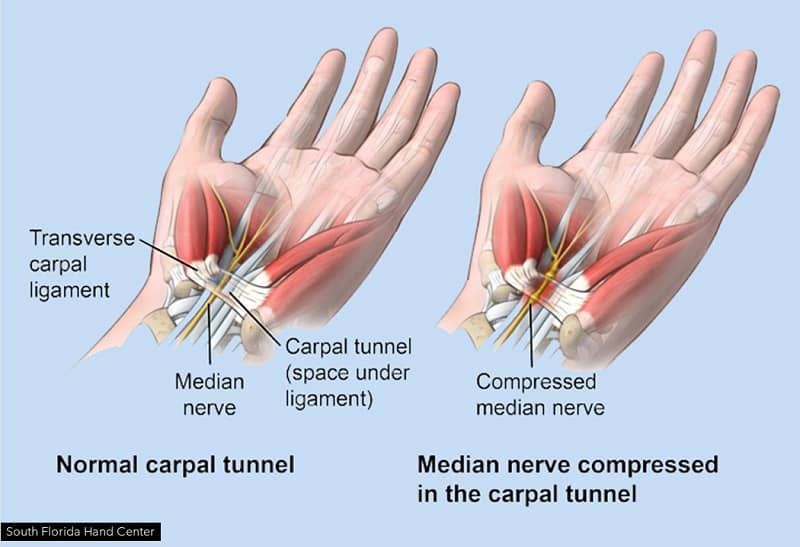 Carpal Tunnel Syndrome