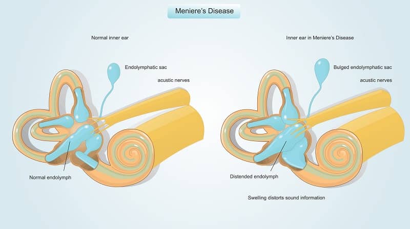 How to know if you have Meniere’s disease