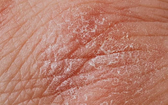 What Causes Small Dry Patches on Skin