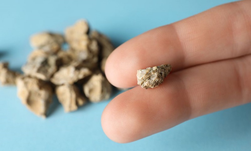 do most kidney stones pass on their own
