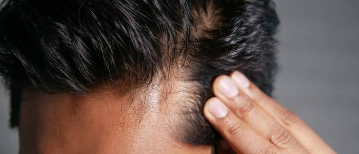 dianabol side effects hair loss