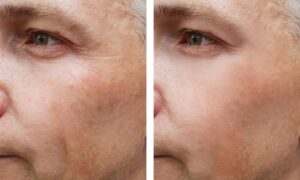 facial yoga before after