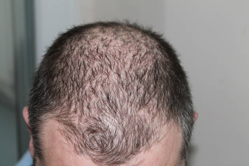 How to Stop Hair Loss After Steroid Cycle: At-Home Remedies
