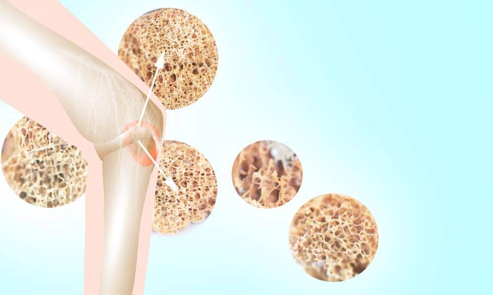 how to increase bone density after 30