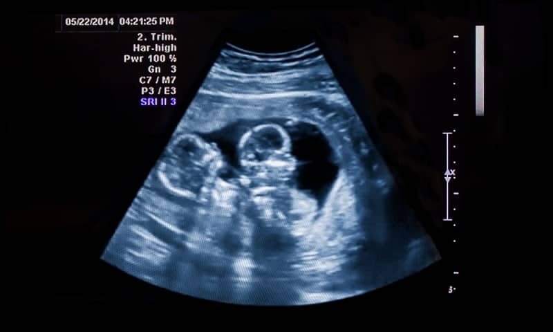 how to tell if twins are identical or fraternal from ultrasound